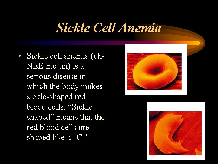 Sickle Cell Anemia • Sickle cell anemia (uh. NEE-me-uh) is a serious disease in
