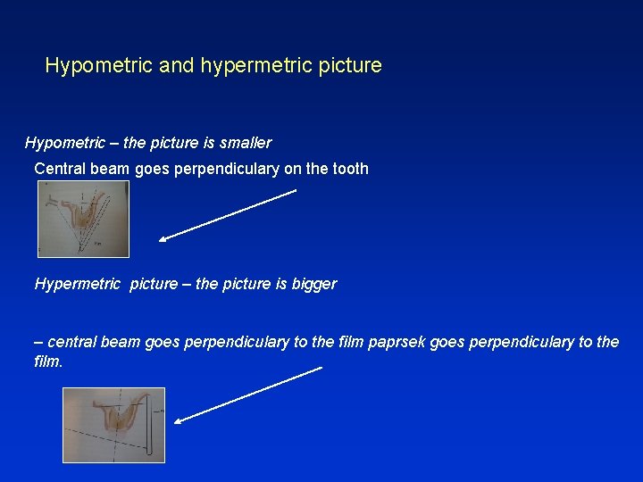 Hypometric and hypermetric picture Hypometric – the picture is smaller Central beam goes perpendiculary
