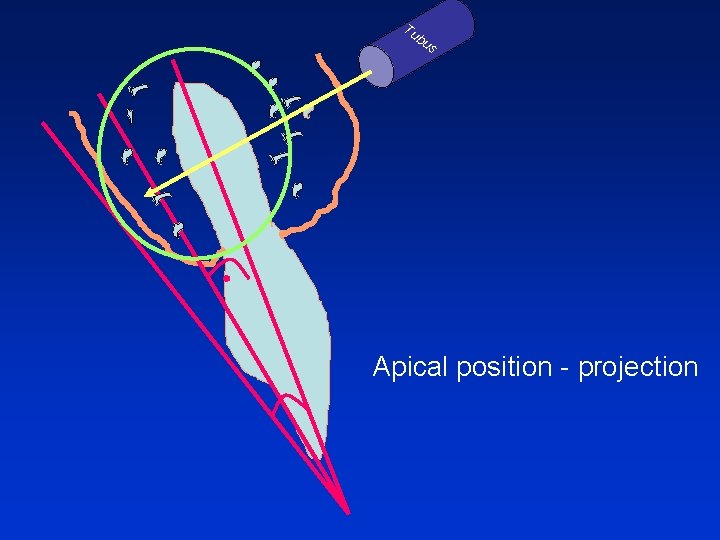 Tu bu s Apical position - projection 