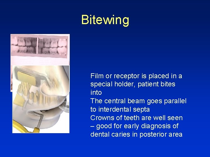Bitewing Film or receptor is placed in a special holder, patient bites into The