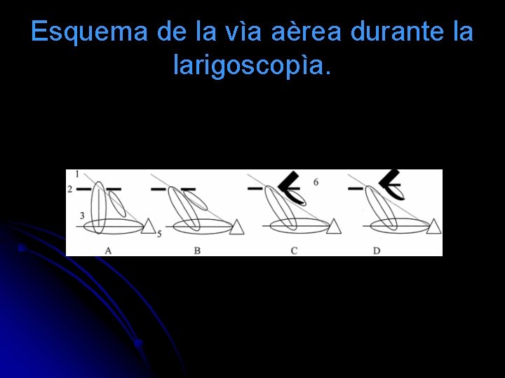 Esquema de la vìa aèrea durante la larigoscopìa. 