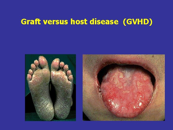 Graft versus host disease (GVHD) 