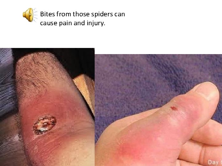 Bites from those spiders can cause pain and injury. 