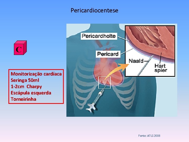 Pericardiocentese C Monitorização cardíaca Seringa 50 ml 1 -2 cm Charpy Escápula esquerda Torneirinha