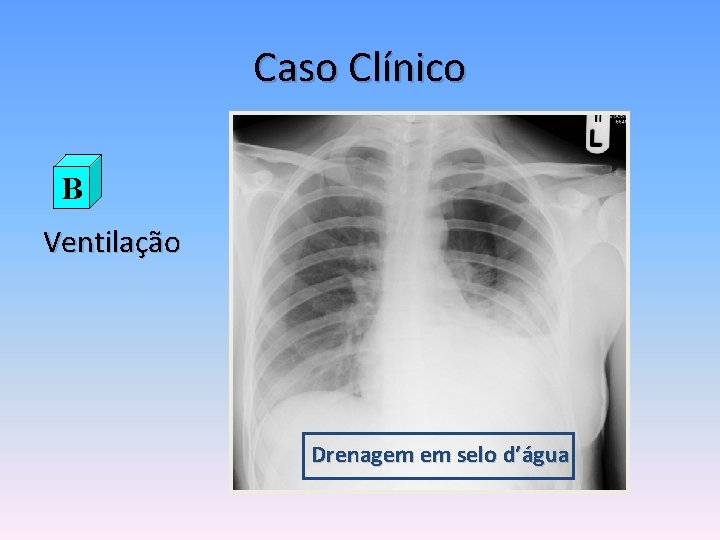 Caso Clínico B Ventilação Drenagem em selo d’água 