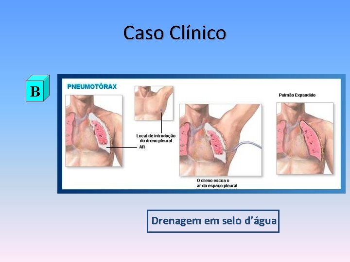 Caso Clínico B Drenagem em selo d’água 