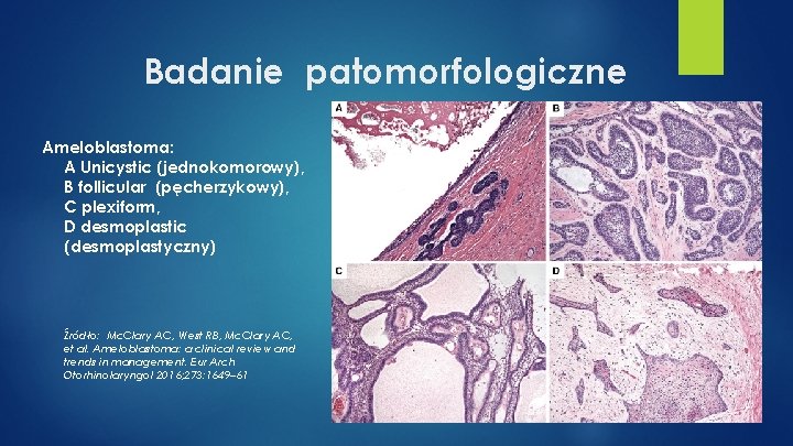 Badanie patomorfologiczne Ameloblastoma: A Unicystic (jednokomorowy), B follicular (pęcherzykowy), C plexiform, D desmoplastic (desmoplastyczny)
