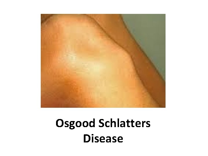 Osgood Schlatters Disease 