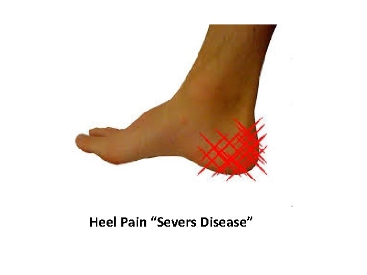 Heel Pain “Severs Disease” 