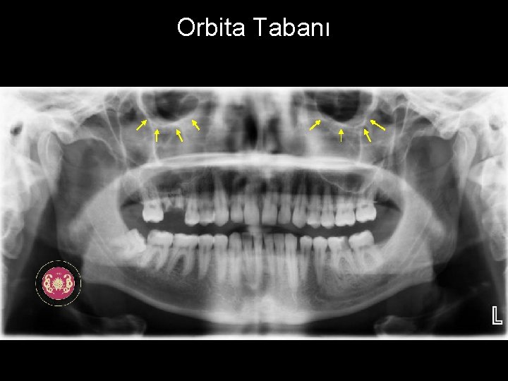 Orbita Tabanı 