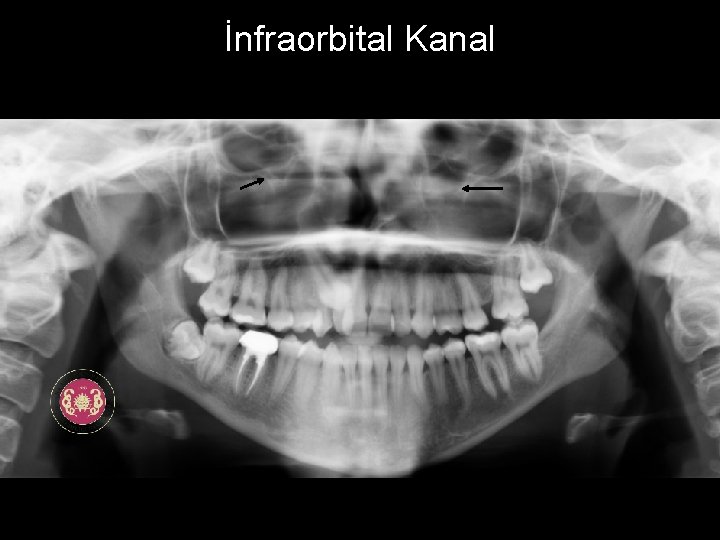 İnfraorbital Kanal 