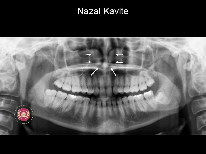 Nazal Kavite 