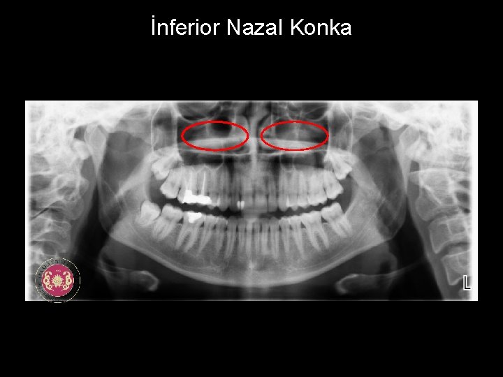 İnferior Nazal Konka 