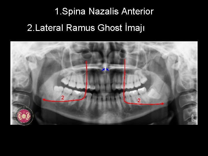 1. Spina Nazalis Anterior 2. Lateral Ramus Ghost İmajı 1 2 2 