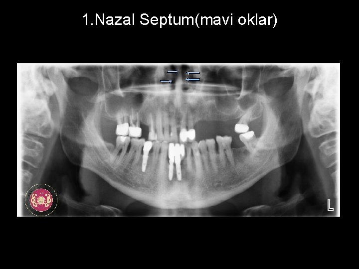 1. Nazal Septum(mavi oklar) 
