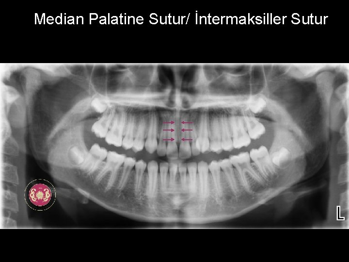 Median Palatine Sutur/ İntermaksiller Sutur 