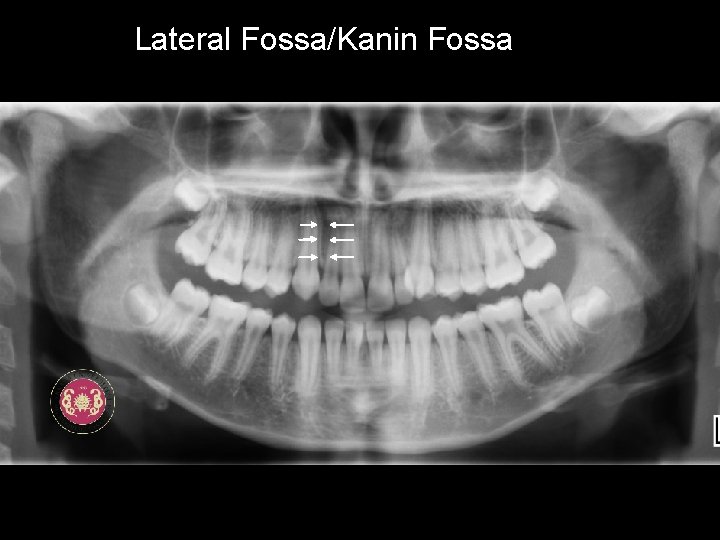 Lateral Fossa/Kanin Fossa 