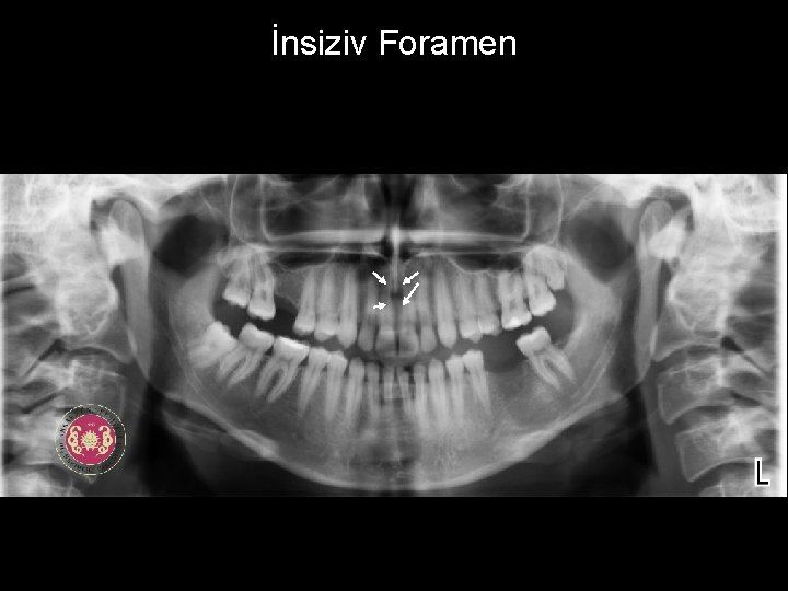 İnsiziv Foramen 