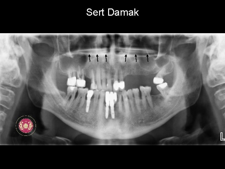 Sert Damak 