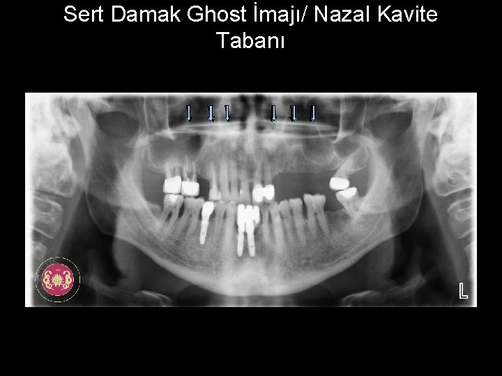 Sert Damak Ghost İmajı/ Nazal Kavite Tabanı 