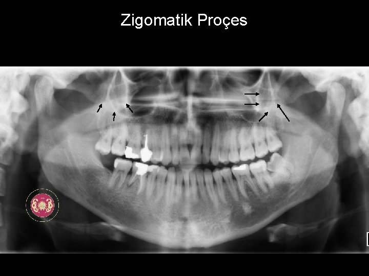 Zigomatik Proçes 