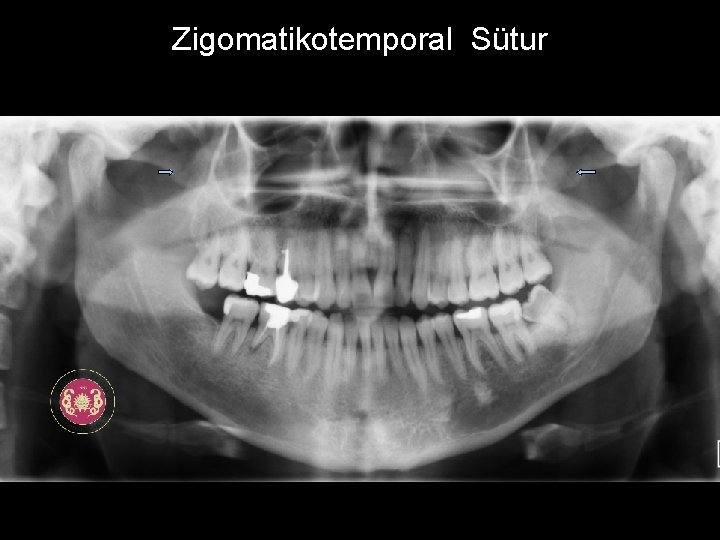 Zigomatikotemporal Sütur 