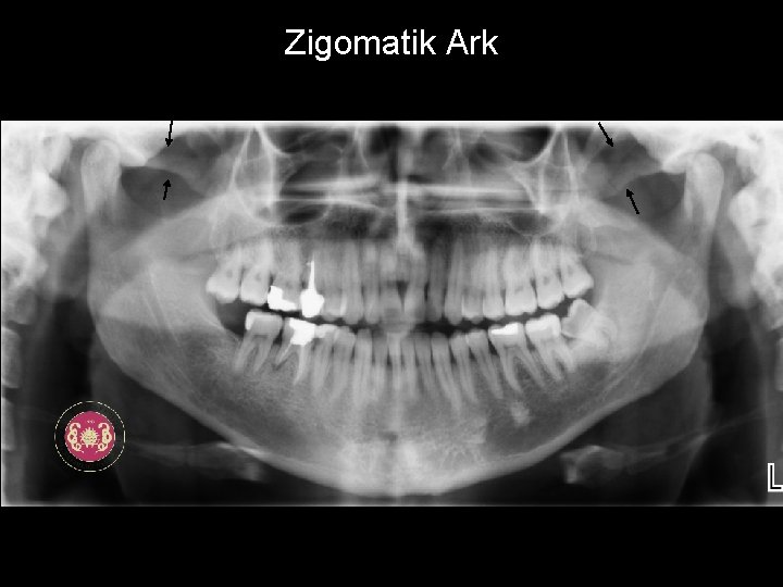 Zigomatik Ark 
