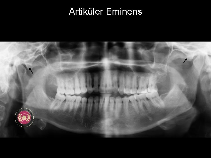 Artiküler Eminens 