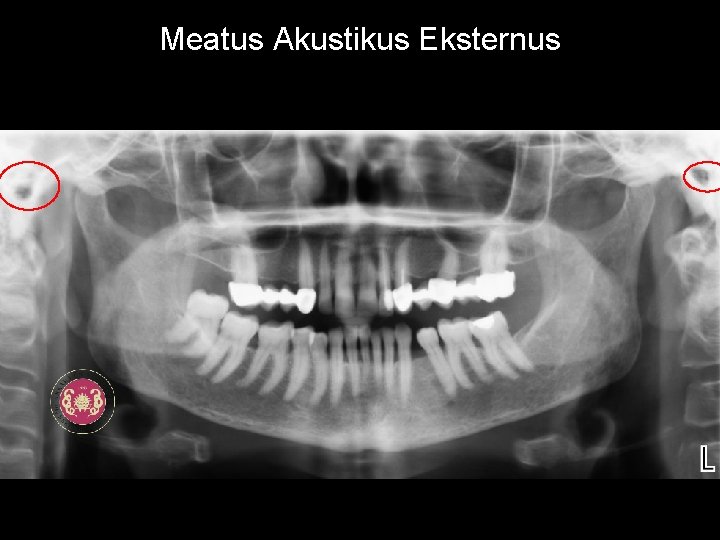 Meatus Akustikus Eksternus 