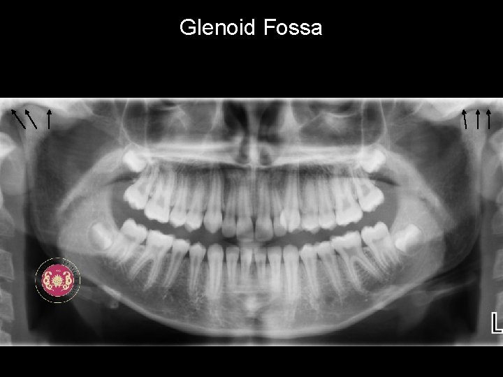 Glenoid Fossa 