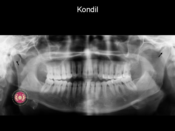 Kondil 
