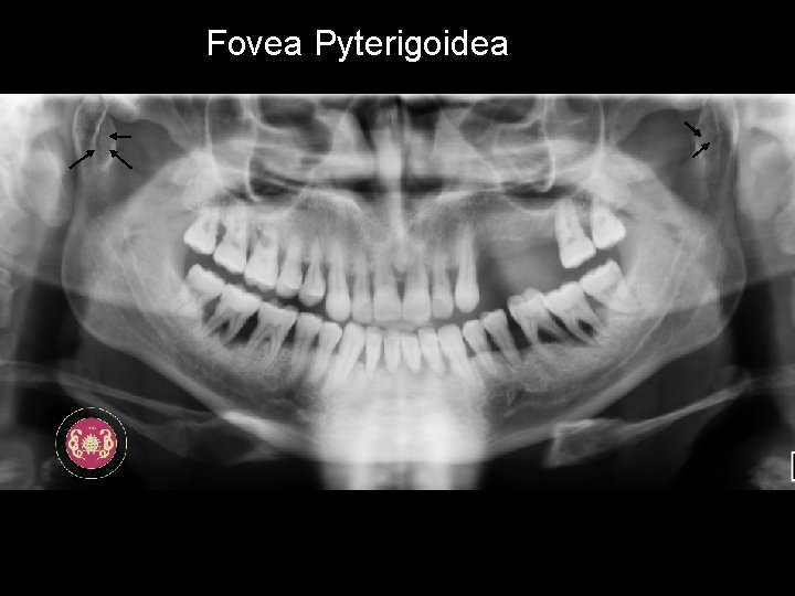 Fovea Pyterigoidea 