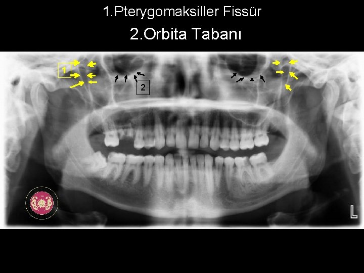 1. Pterygomaksiller Fissür ' 2. Orbita Tabanı 1 2 