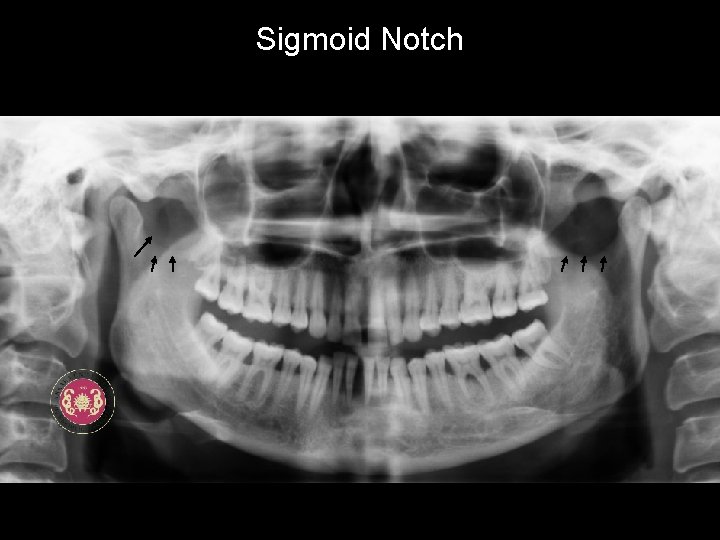 Sigmoid Notch 