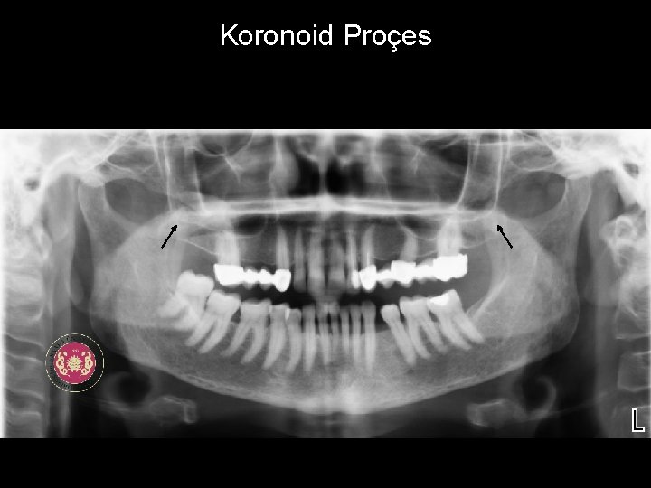 Koronoid Proçes 
