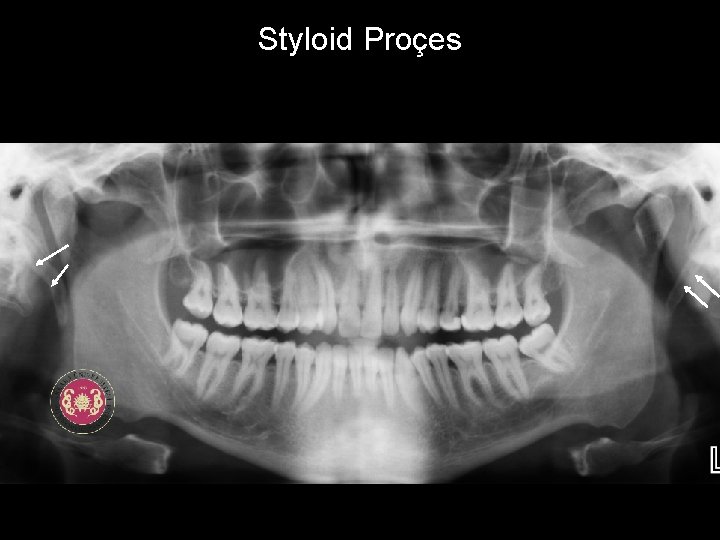 Styloid Proçes 