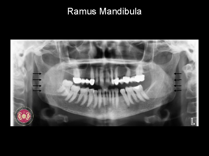 Ramus Mandibula 