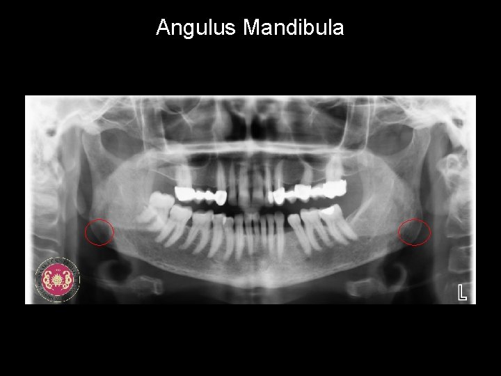 Angulus Mandibula 
