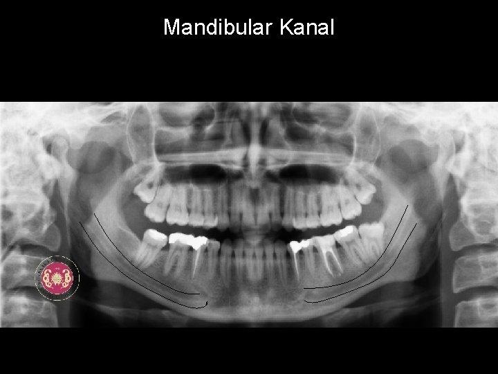 Mandibular Kanal 