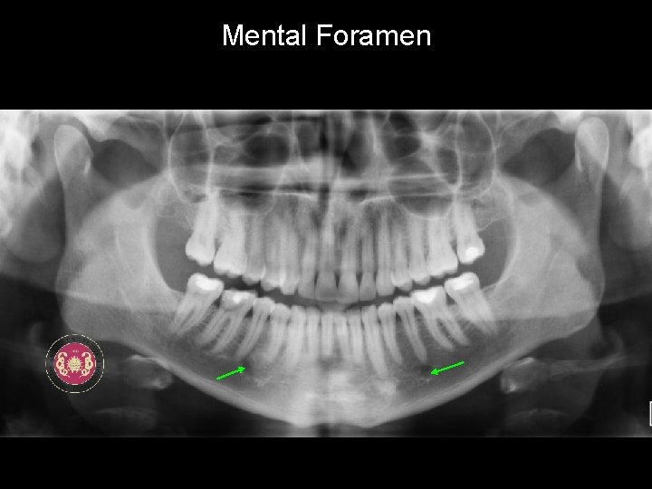 Mental Foramen 