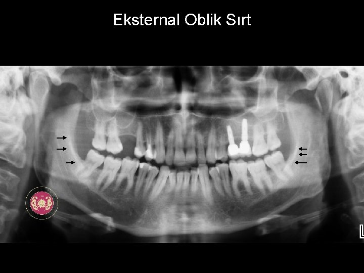 Eksternal Oblik Sırt 