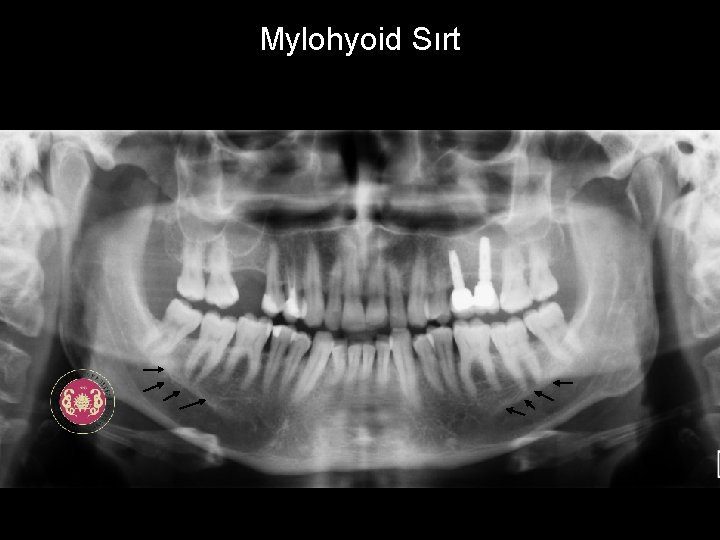Mylohyoid Sırt 