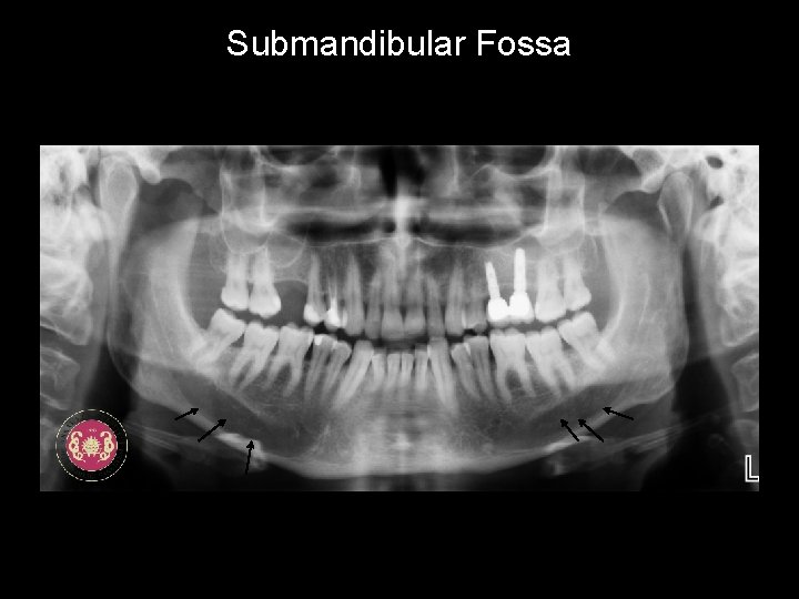 Submandibular Fossa 