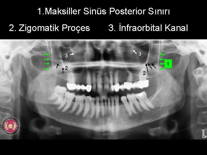 1. Maksiller Sinüs Posterior Sınırı 2. Zigomatik Proçes 3 2 3. İnfraorbital Kanal 3
