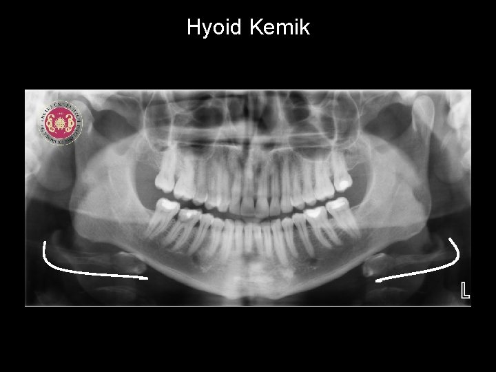 Hyoid Kemik 