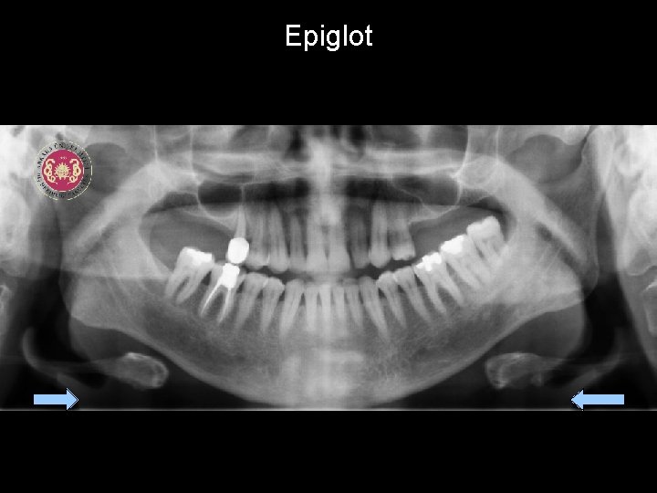 Epiglot 