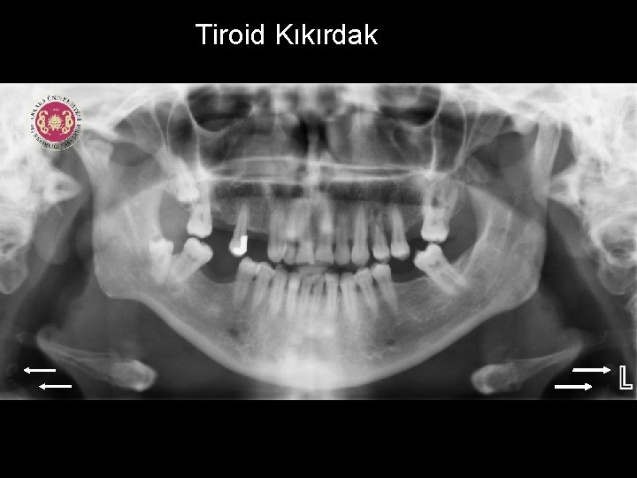 Tiroid Kıkırdak 