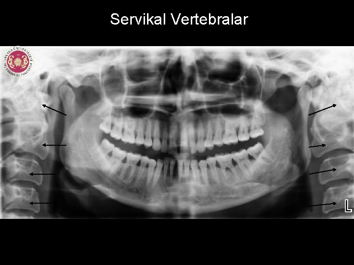 Servikal Vertebralar 