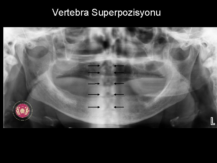 Vertebra Superpozisyonu 