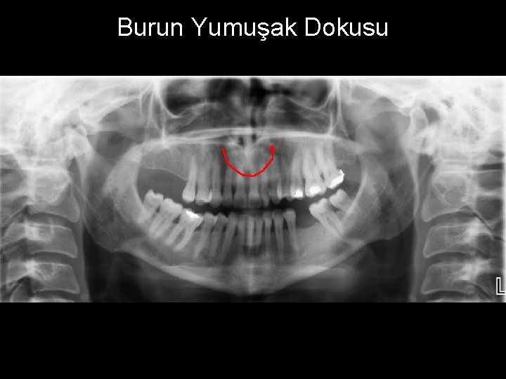 Burun Yumuşak Dokusu 